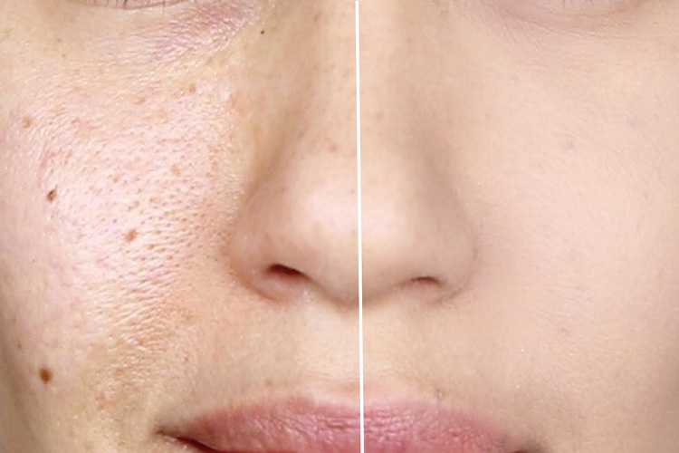 Lỗ chân lông to do thiếu hụt collagen và elastin
