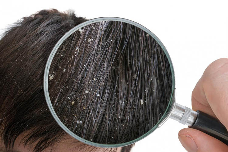 Gàu là tình trạng da đầu bong tróc và có những mảng vảy