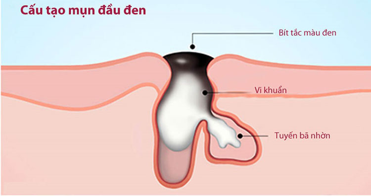 Tuyến bã nhờn hoạt động mạnh, nhất là vùng mũi, vùng trán, khiến lỗ chân lông bị bít tắc