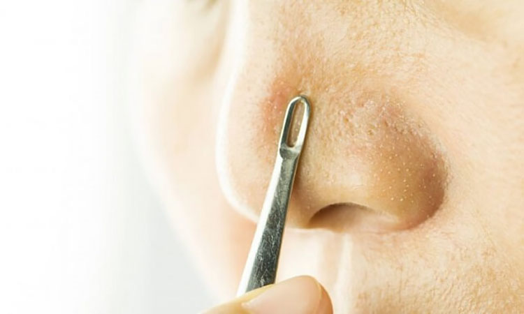 Khi bị gặp tình trạng mụn đầu đen, nhiều người có thói quen cạy, nặn
