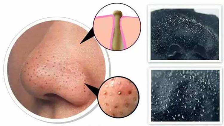 Cách trị mụn đầu đen ở mũi