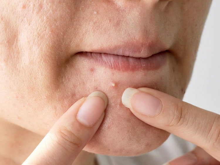 Tự nặn mụn tại nhà làm tăng nguy cơ viêm nhiễm