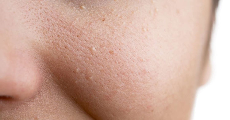 Mụn ẩn xuất hiện do sự tích tụ bụi bẩn, bã nhờn ở lỗ chân lông